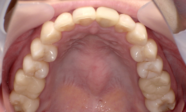 部分矯正 上の部分矯正の症例写真