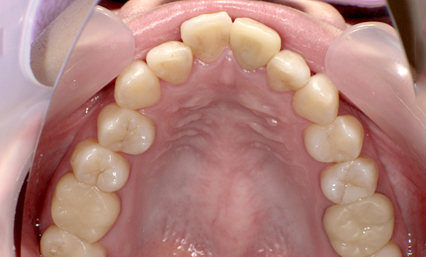 部分矯正 上の部分矯正の症例写真