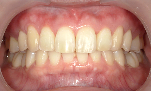部分矯正 上の部分矯正の症例写真