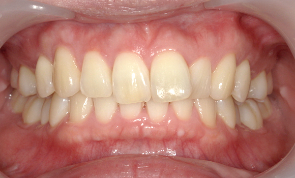 部分矯正 上の部分矯正の症例写真