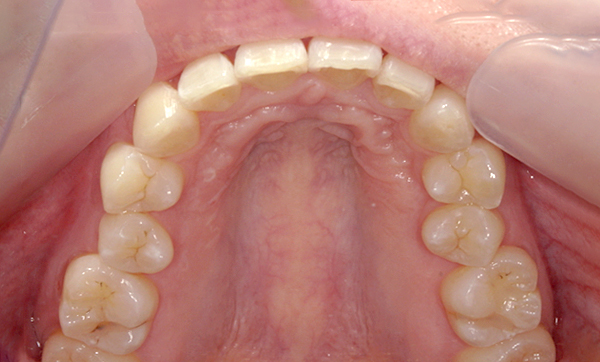 部分矯正 上の部分矯正の症例写真