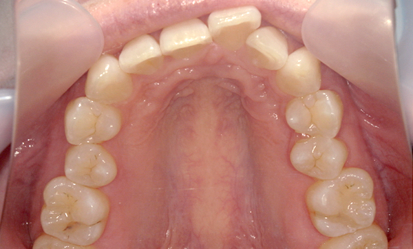 部分矯正 上の部分矯正の症例写真