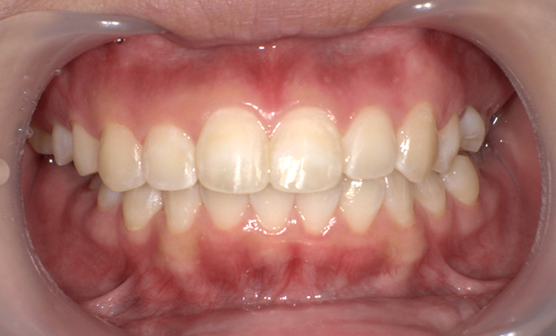 部分矯正 出っ歯の部分矯正の症例写真