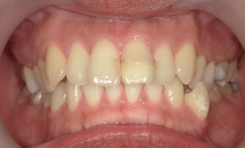 部分矯正 出っ歯の部分矯正の症例写真