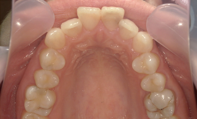 部分矯正 出っ歯の部分矯正の症例写真