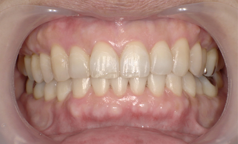 部分矯正 出っ歯の部分矯正の症例写真