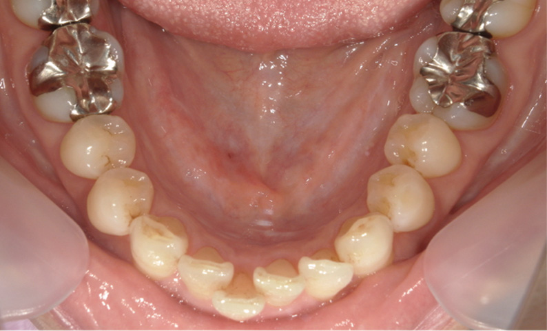 部分矯正 出っ歯の部分矯正の症例写真