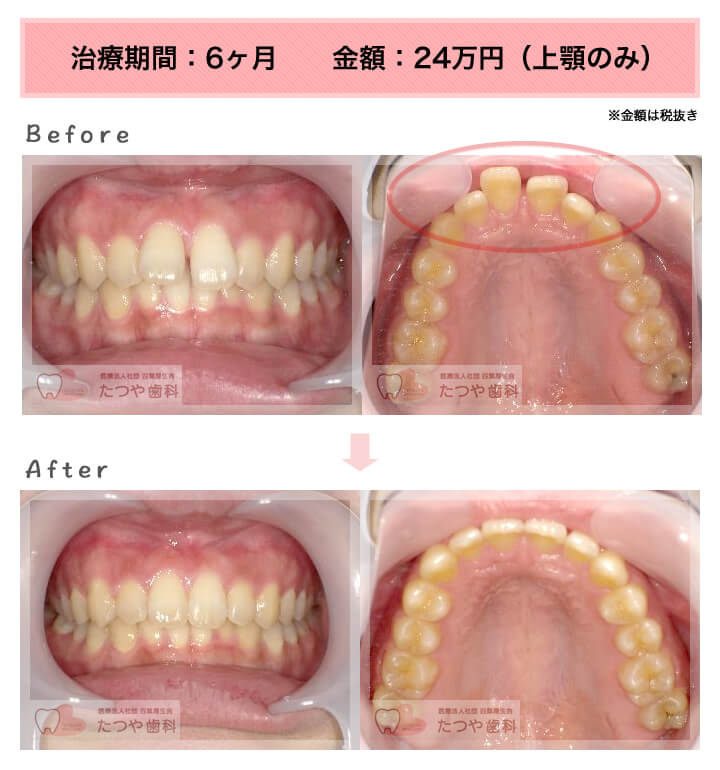 部分矯正の症例　出っ歯