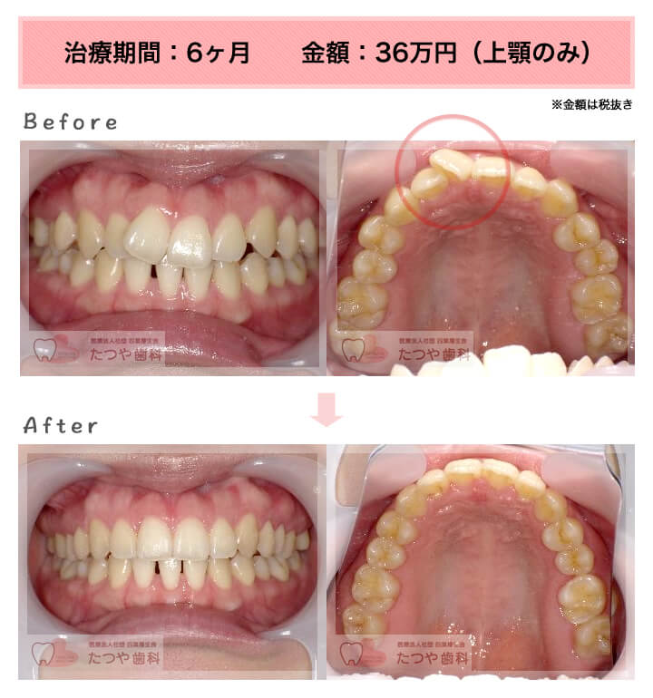 部分矯正の症例　前歯1本だけ