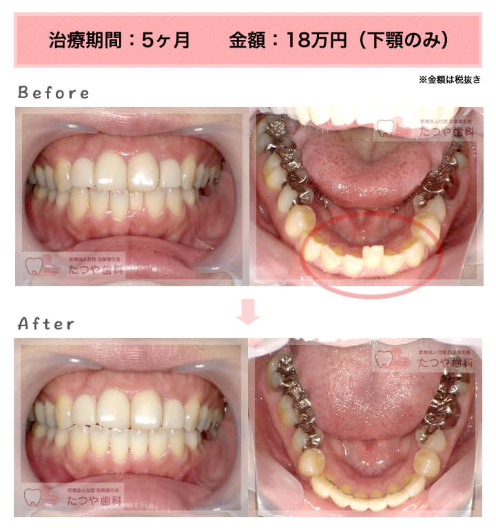 部分矯正の症例　前歯1本だけ