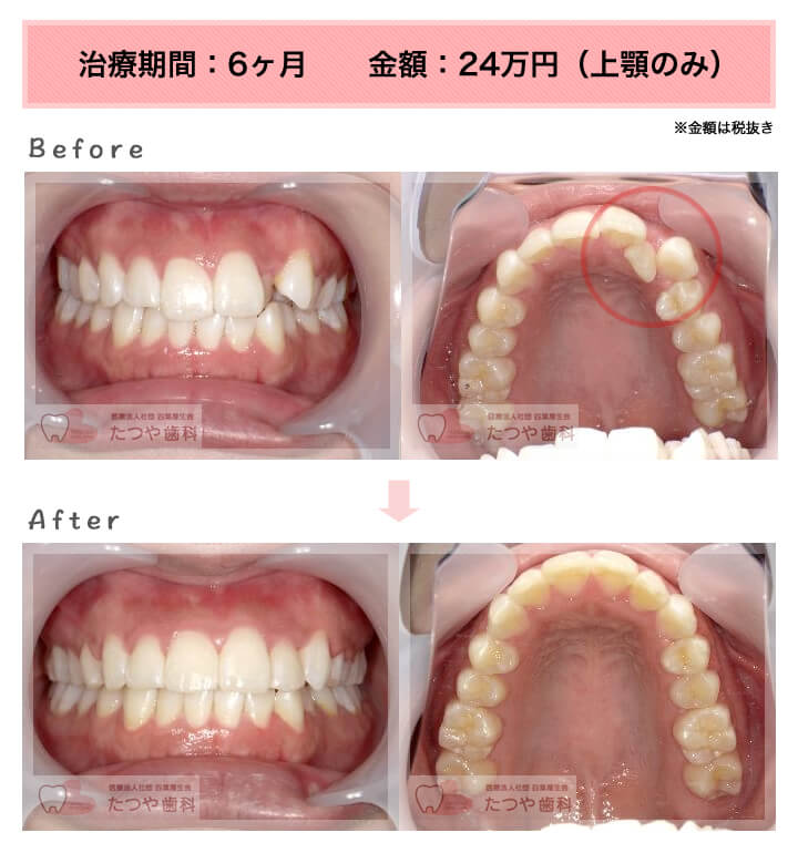 部分矯正の症例　前歯1本だけ