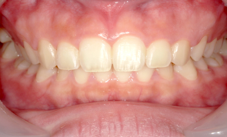 「前歯1本だけ」部分矯正の症例