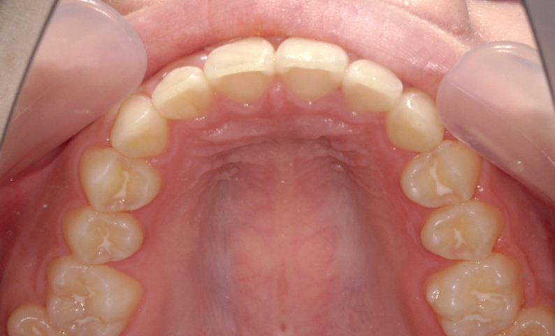 「前歯1本だけ」部分矯正の症例