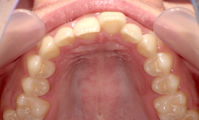 「前歯1本だけ」部分矯正の症例