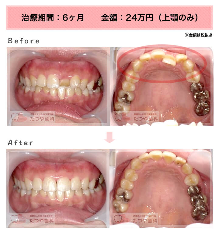 前歯1本だけ 症例紹介 東京の 安い前歯だけの部分矯正 部分矯正のたつや歯科