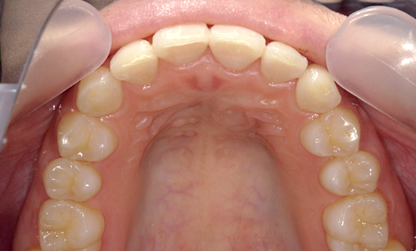 「前歯1本だけ」部分矯正の症例