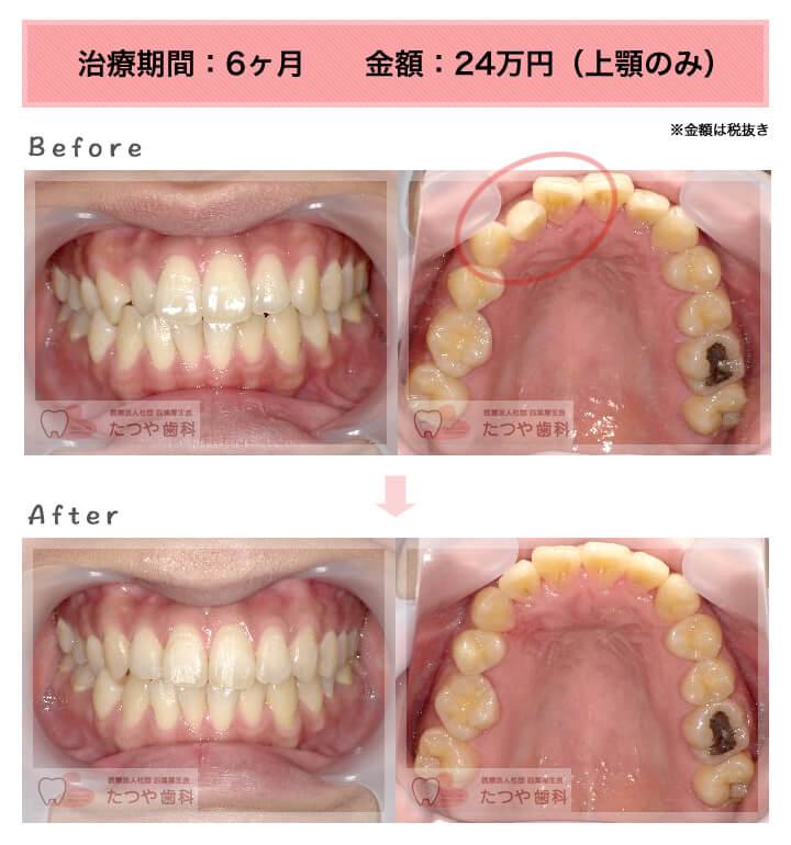 部分矯正の症例　前歯1本だけ