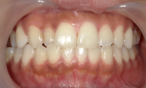 「前歯1本だけ」部分矯正の症例