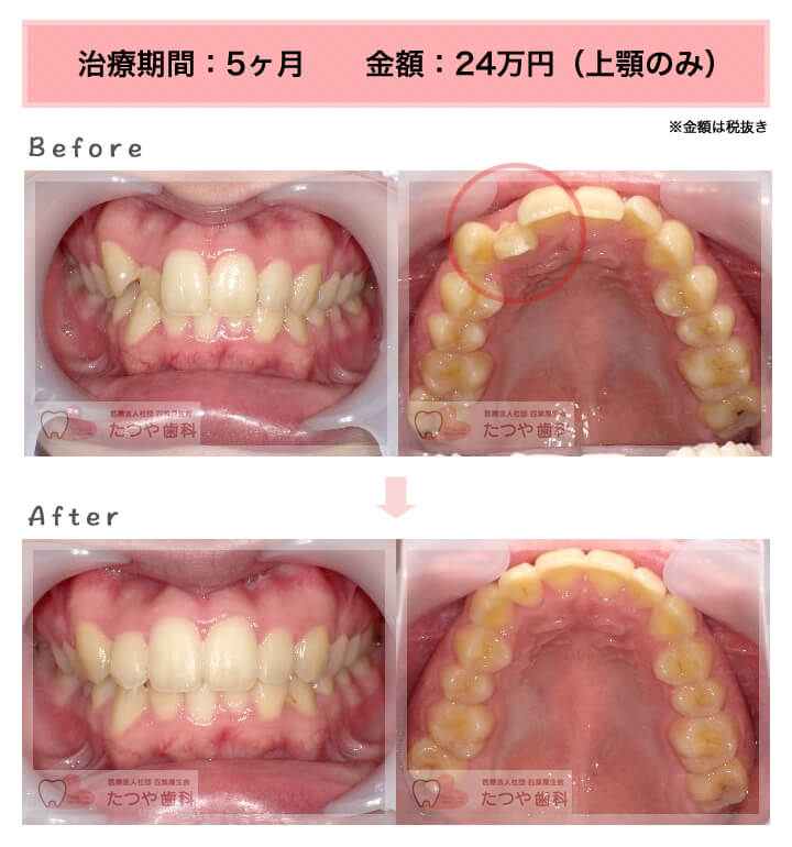 部分矯正の症例　前歯1本だけ