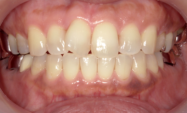 「前歯1本だけ」部分矯正の症例