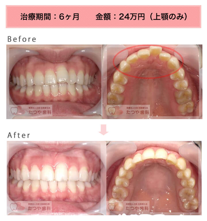 部分矯正の症例　前歯1本だけ