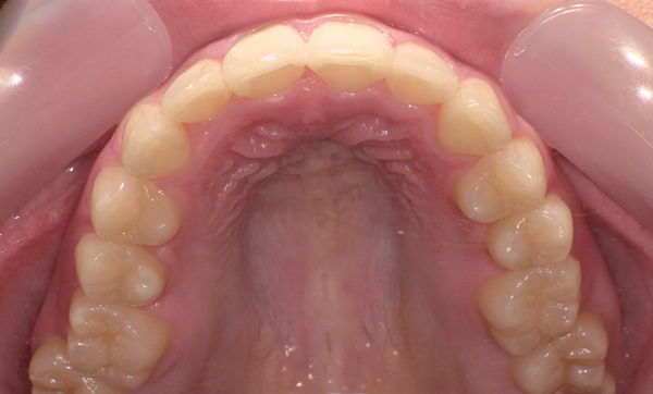 「前歯1本だけ」部分矯正の症例