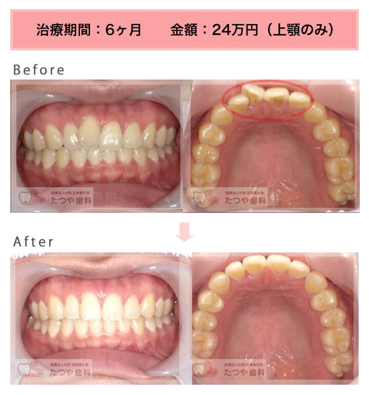 部分矯正の症例　前歯1本だけ