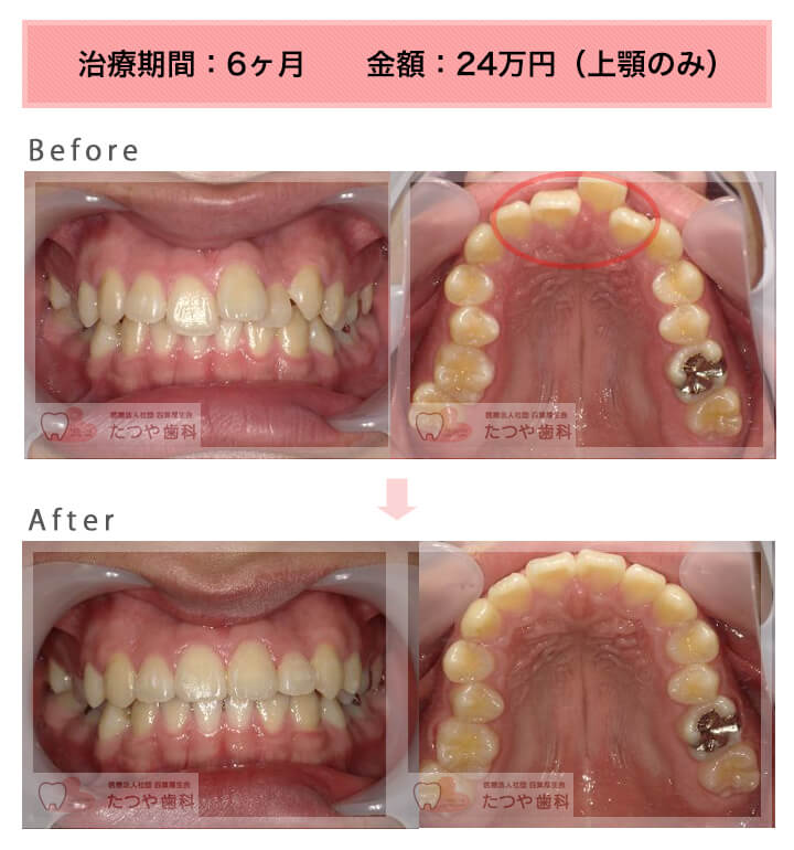 部分矯正の症例　前歯1本だけ