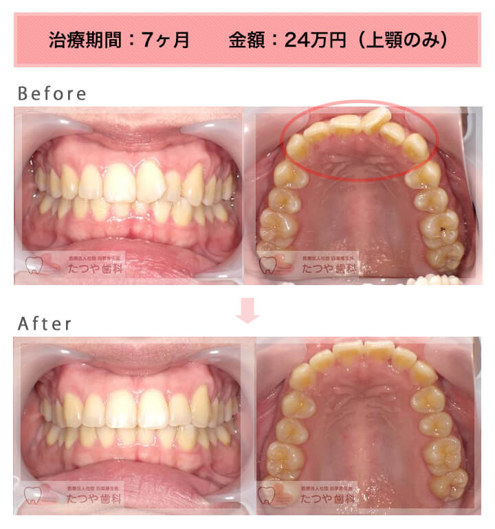 部分矯正の症例　前歯1本だけ