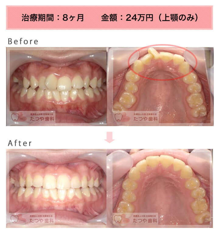 部分矯正の症例　前歯1本だけ