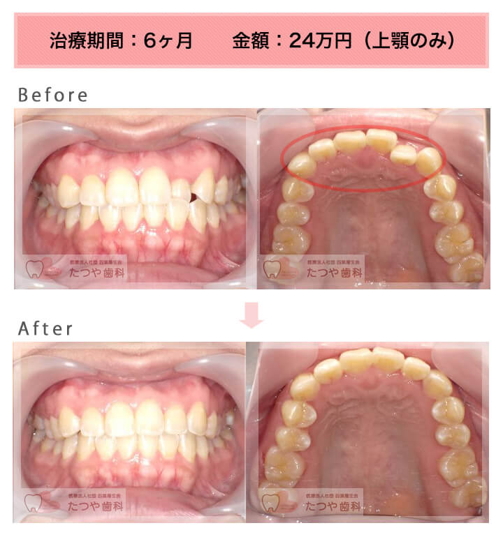 部分矯正の症例　前歯1本だけ