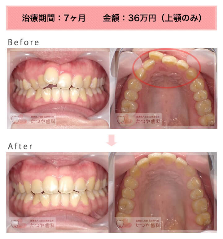 部分矯正の症例　前歯1本だけ