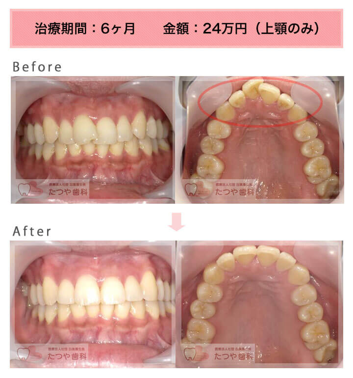 部分矯正の症例　前歯1本だけ