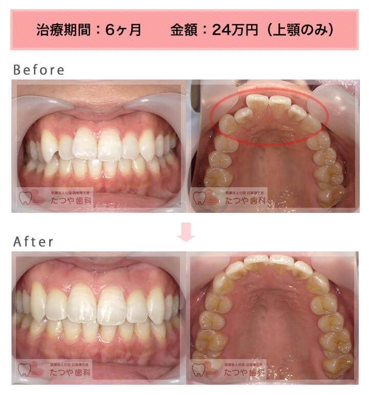 部分矯正の症例　前歯1本だけ