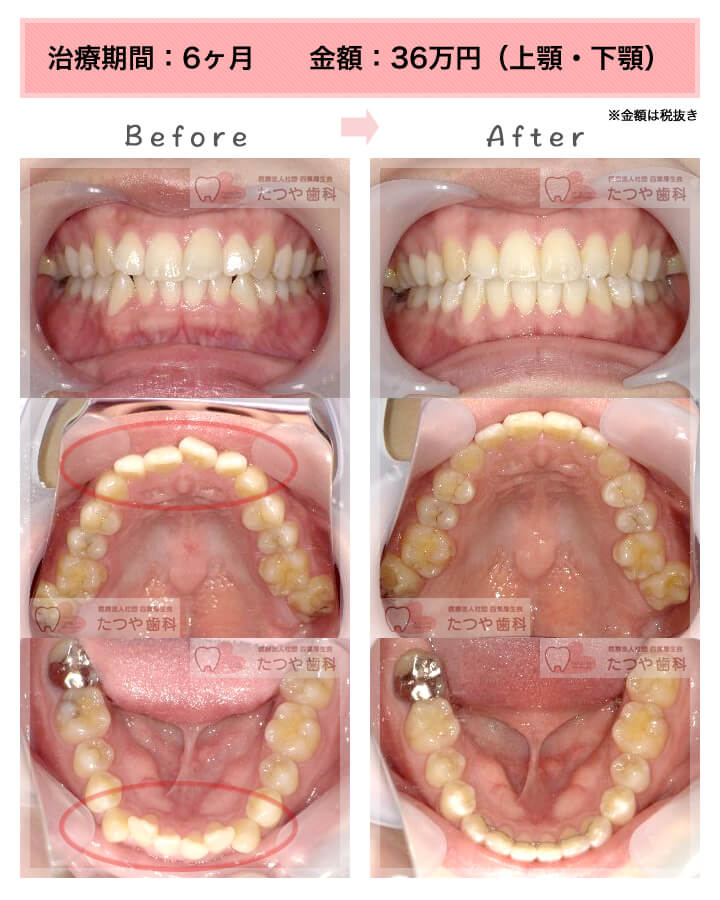 部分矯正の症例　上下の前歯