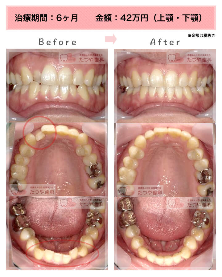 部分矯正の症例　上下の前歯