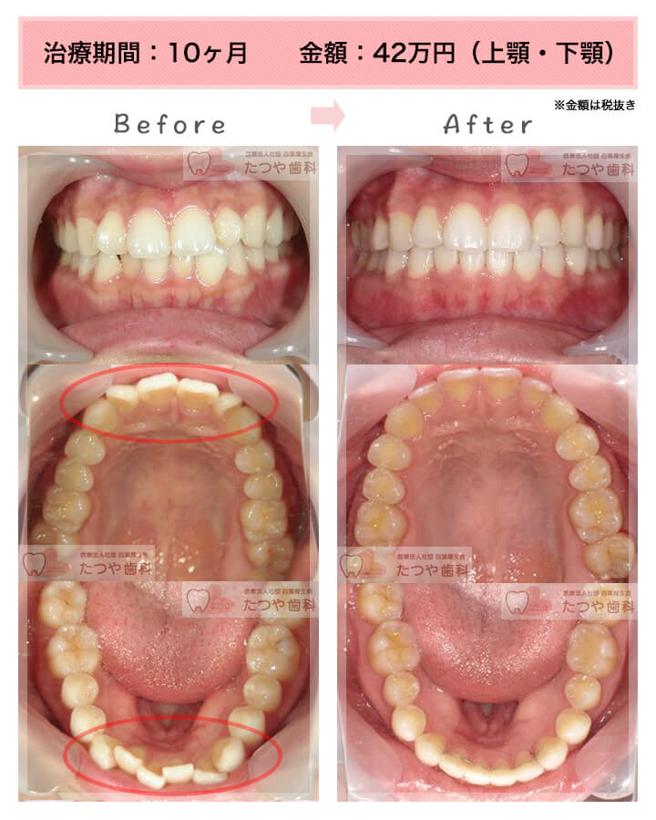 部分矯正の症例　上下の前歯