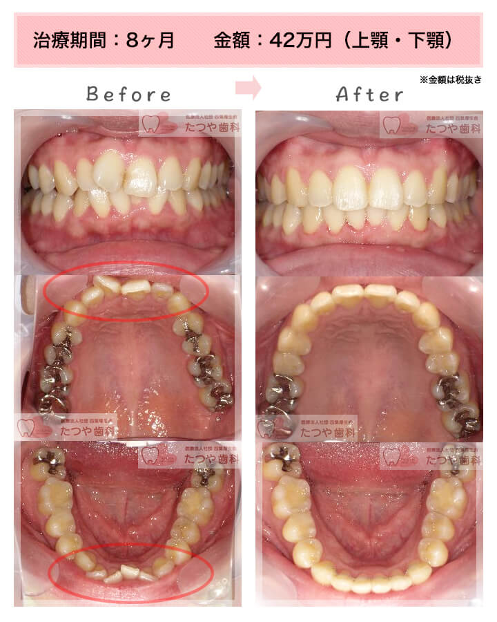 部分矯正の症例　上下の前歯
