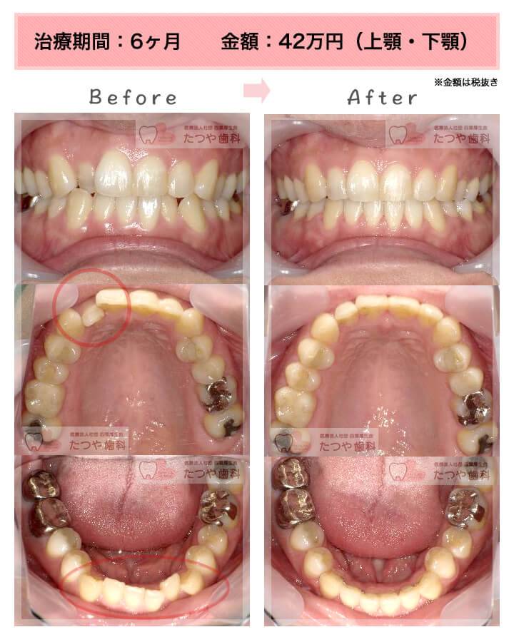 部分矯正の症例　上下の前歯