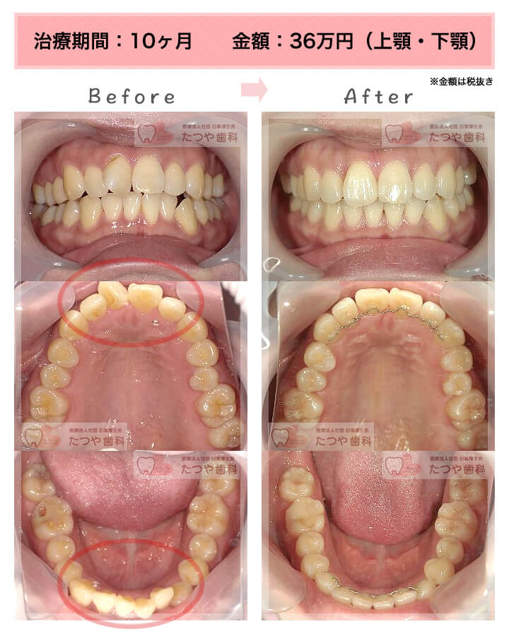部分矯正の症例　上下の前歯