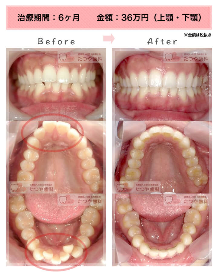 部分矯正の症例　上下の前歯