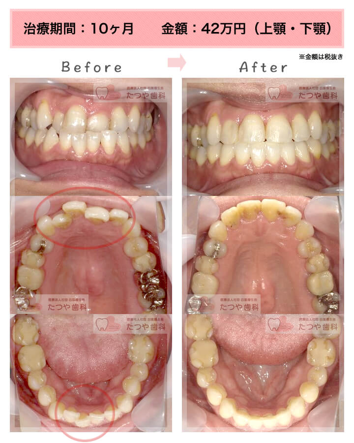 部分矯正の症例　上下の前歯