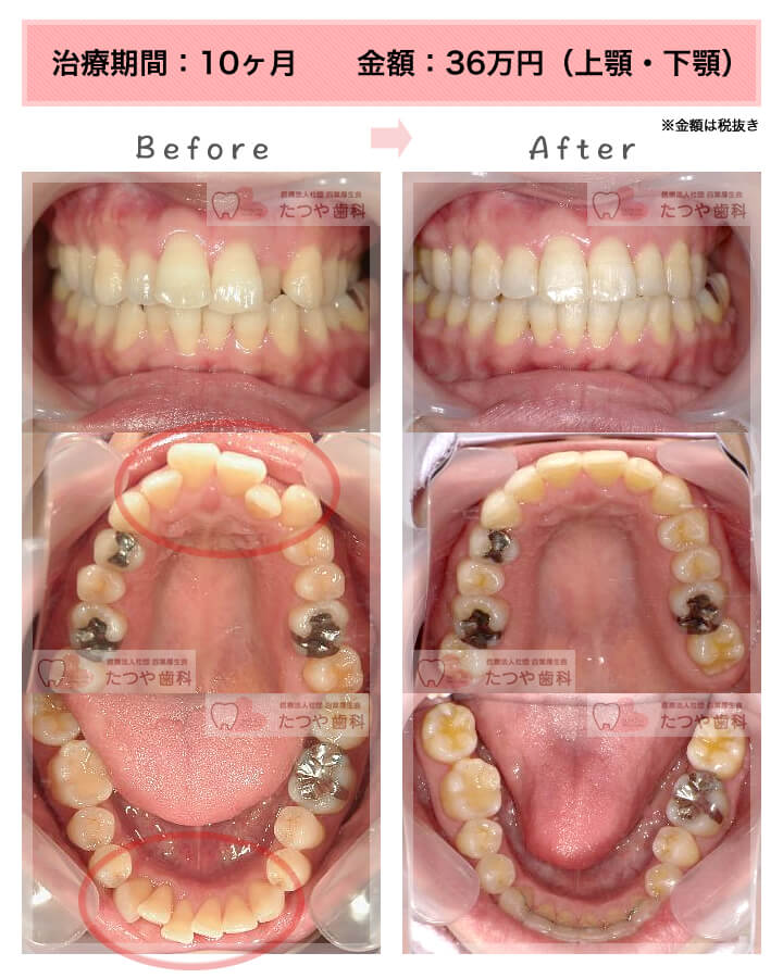部分矯正の症例　上下の前歯
