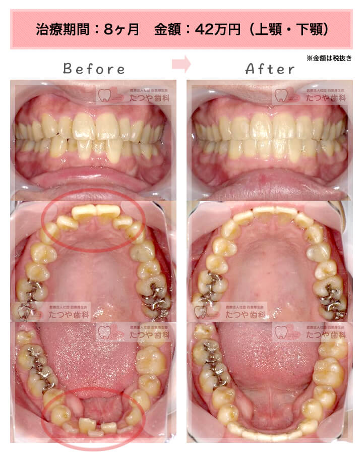 部分矯正の症例　上下の前歯