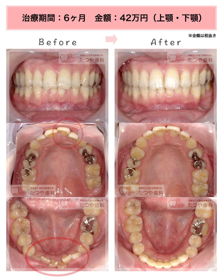 部分矯正の症例　上下の前歯