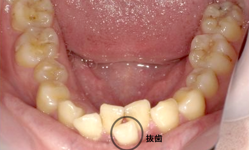 部分矯正 上下の部分矯正の症例写真