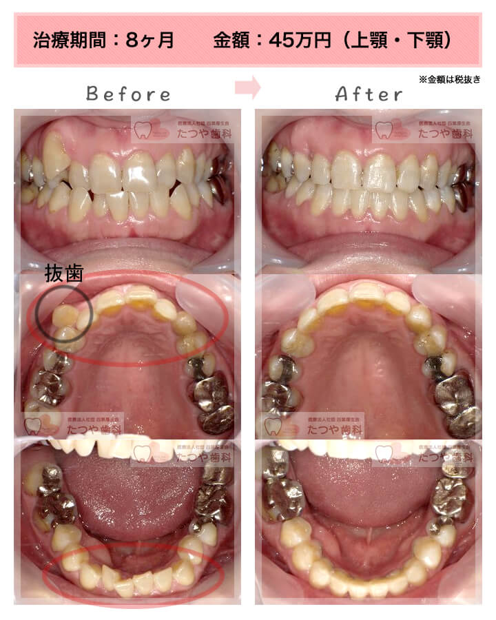 部分矯正の症例　上下の前歯