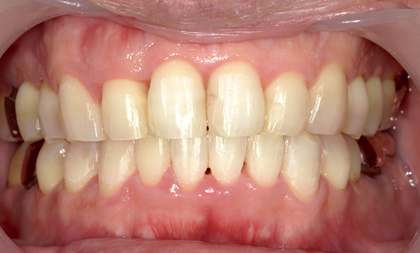 部分矯正 上下の部分矯正の症例写真