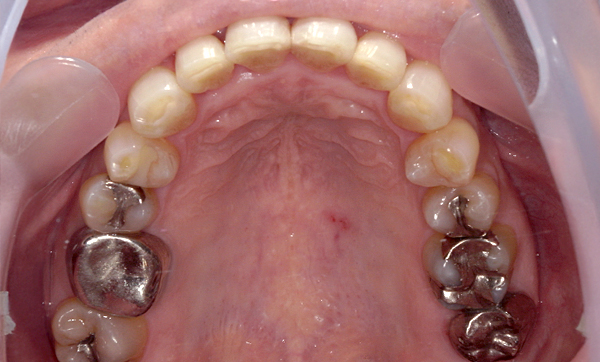 部分矯正 上下の部分矯正の症例写真