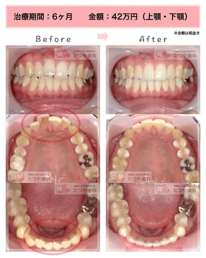 部分矯正の症例　上下の前歯